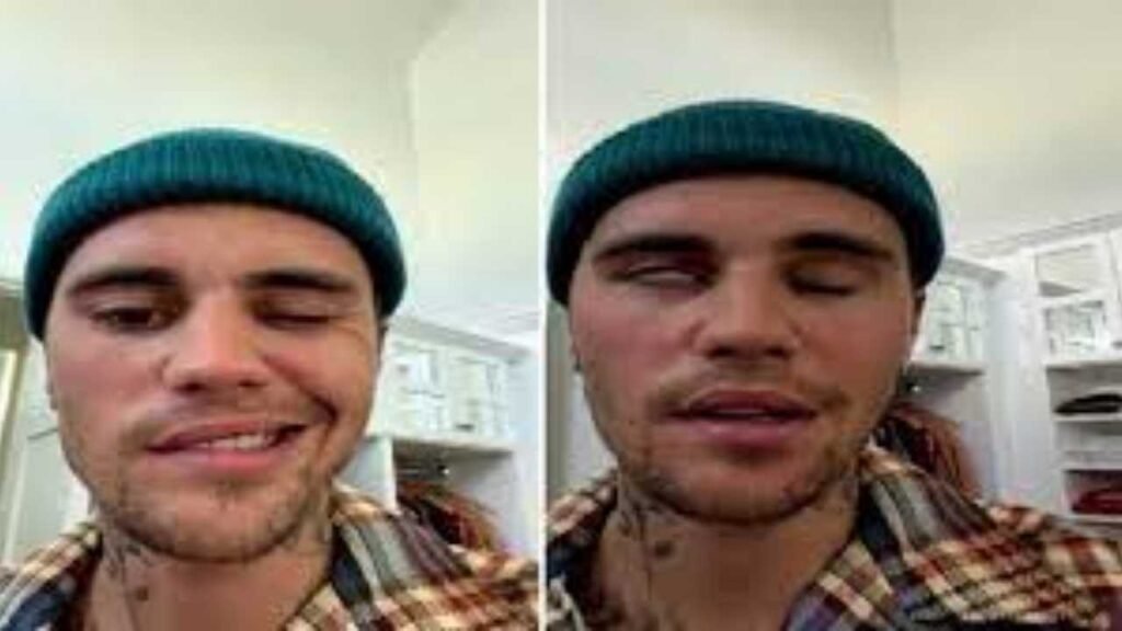 What happened to Justin Bieber’s face?, He himself gave information about this serious disease on Instagram